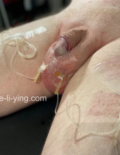 scrotal infusion risks